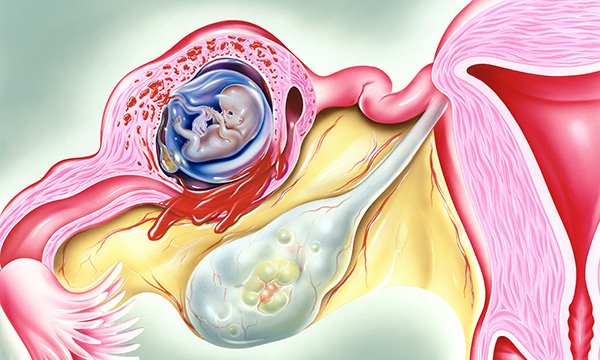 بارداری خارج رحمی