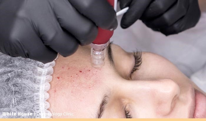 عوارض مزونیدلینگ