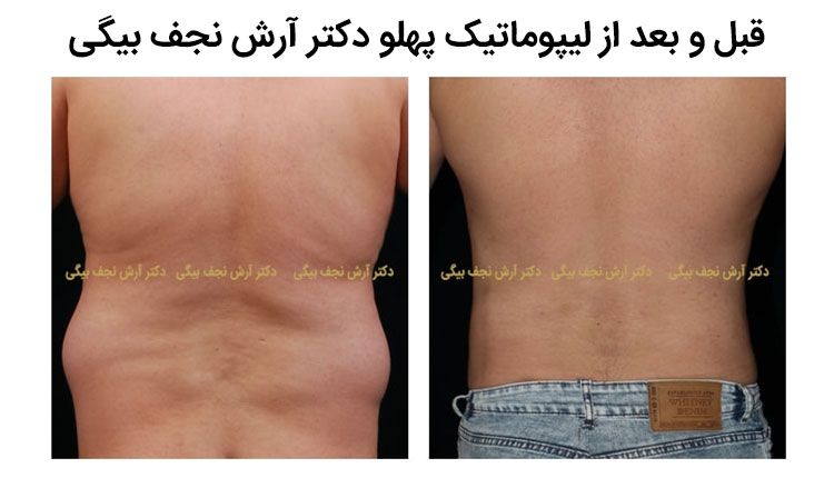 قبل و بعد از لیپوماتیک پهلو دکتر آرش نجف بیگی