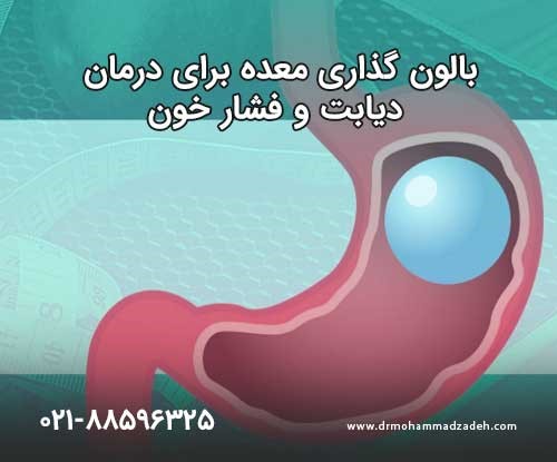 بالون گذاری معده برای درمان دیابت و فشار خون