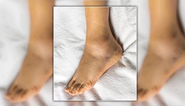 سیاه شدن مچ پا