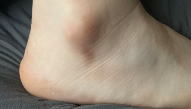 رفع تیرگی قوزک پا