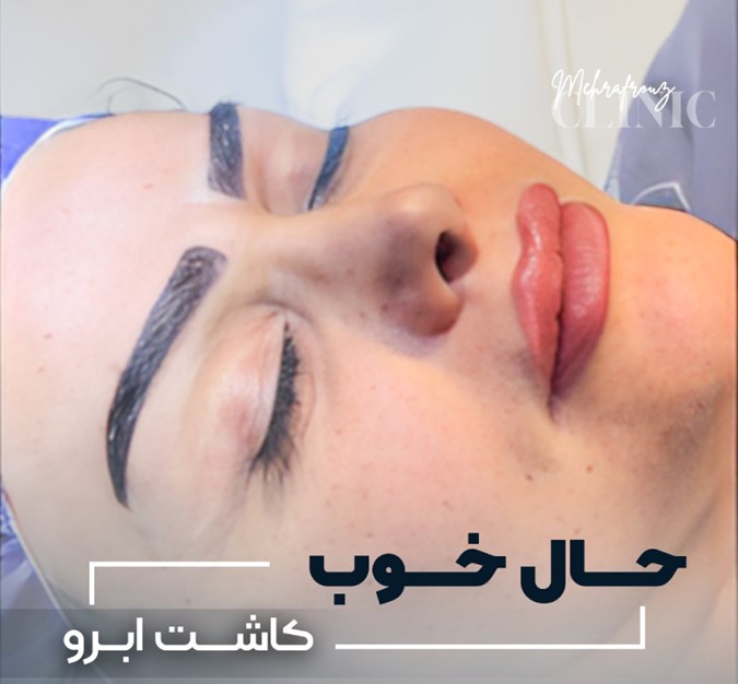 هزینه کاشت ابرو