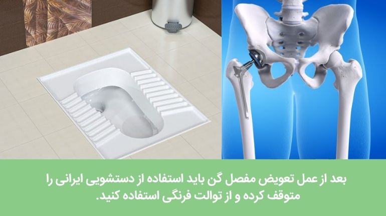 بعد از تعویض مفصل لگن نباید از توالت ایرانی استفاده شود.