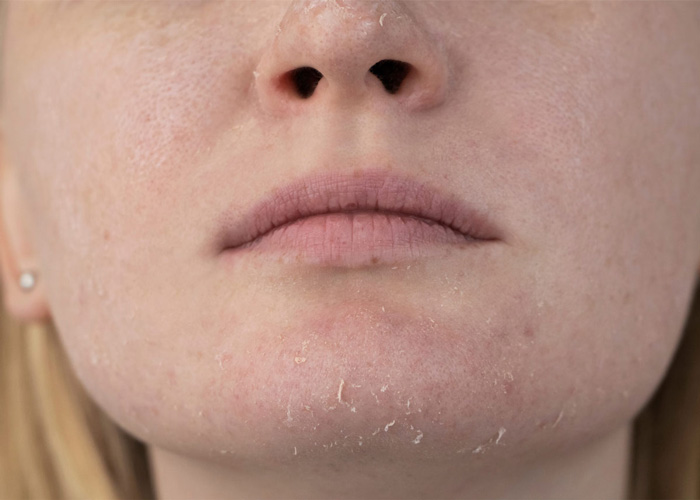 پوست دهیدراته