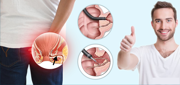 درمان فیستول