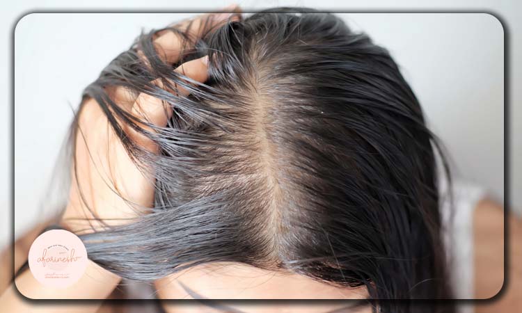 عوامل موثر بر بروز عوارض کاشت مو در زنان