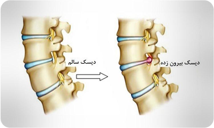 تصویری از ستون فقرات و دیسک کمر سالم در مقایسه با دیسک بیرونزده.