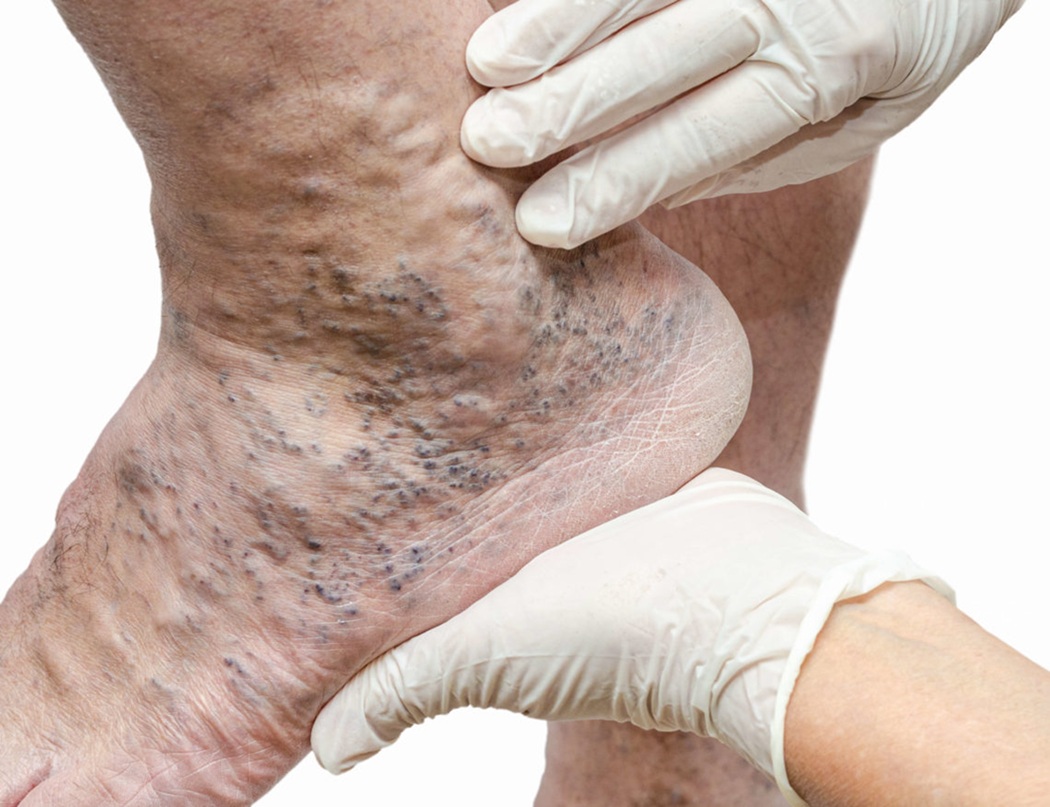 خطرات واریس
