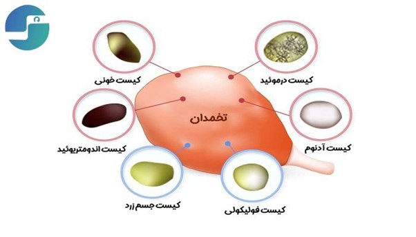 کیست تخمدان و باروری