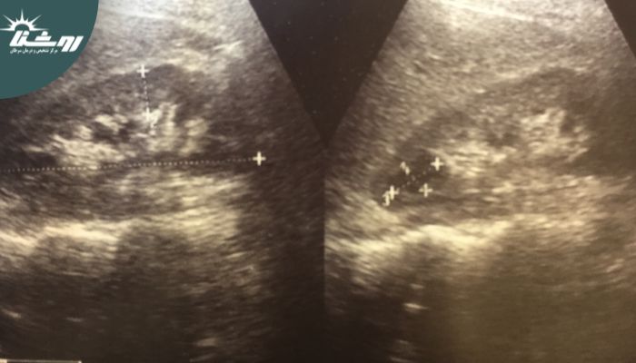 تشخیص کیست کلیه