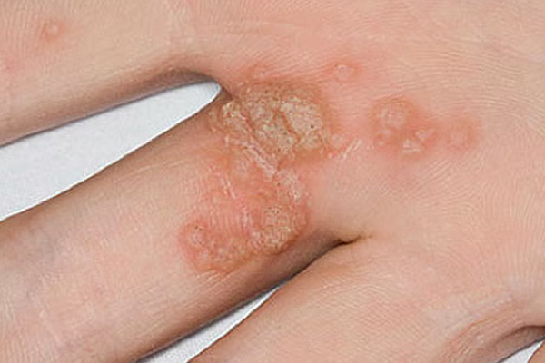 پیشگیری از انتقال HPV