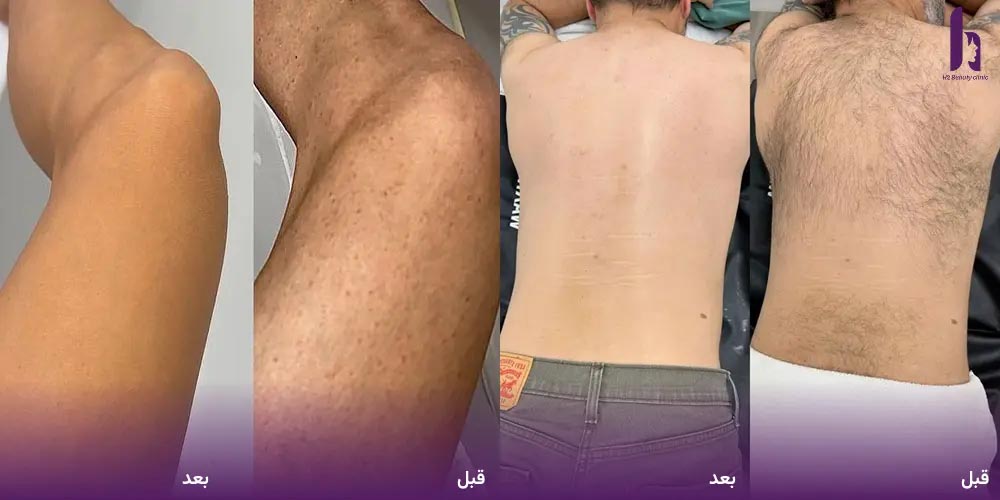 بهترین دستگاه لیزر موهای زائد چیه؟