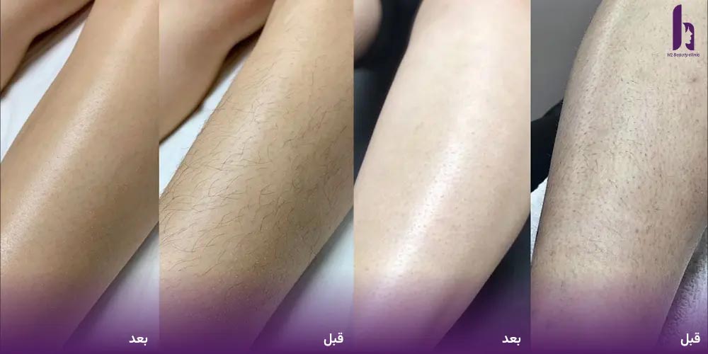 معرفی بهترین برند های تولید کننده لیزر موهای زائد