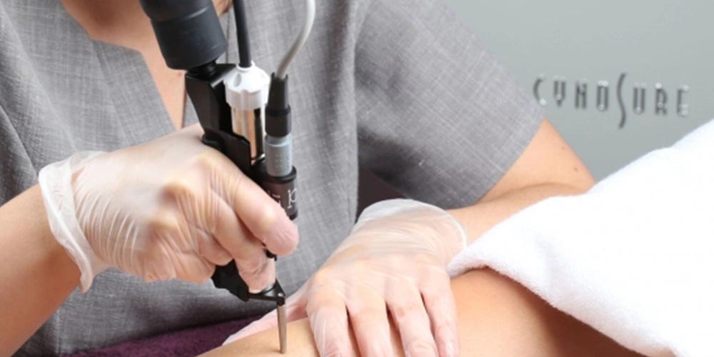 انواع لیزر موهای زائد