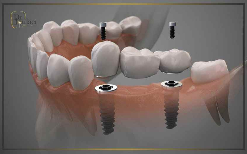 ساخت روکش ایمپلنت ساخت روکش ایمپلنت