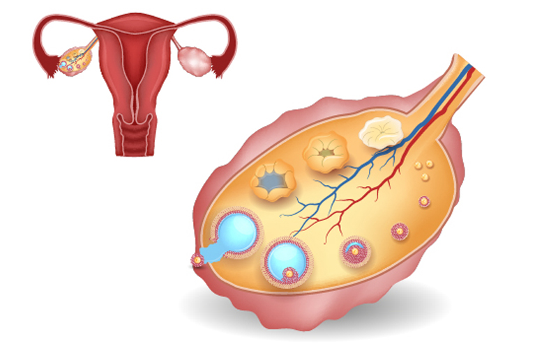 سونوگرافی فولیکول
