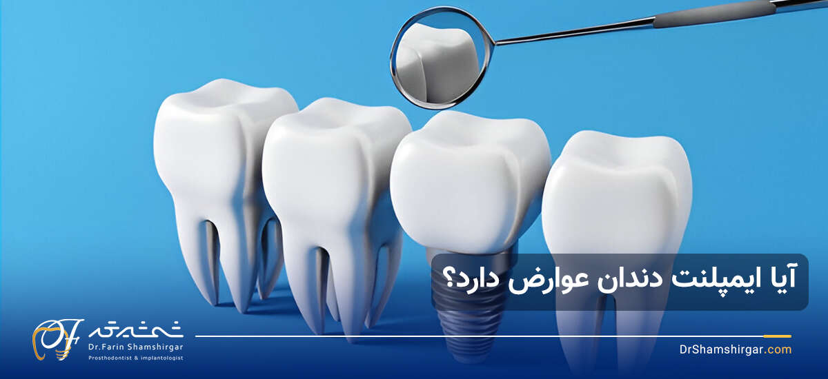 متخصص ایمپلنت دندان در زعفرانیه