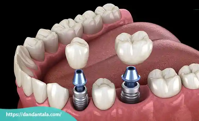 ایمپلنت دندان
