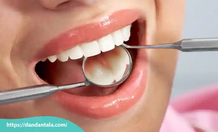 کامپوزیت دندان