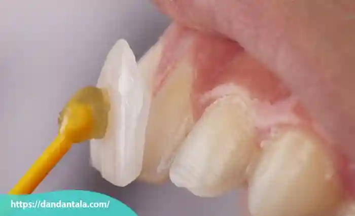 لمینت دندان