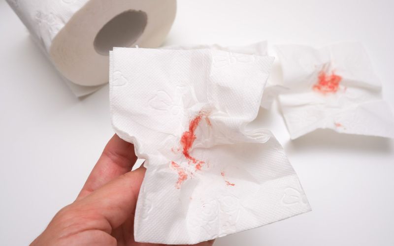 علائم بواسیر در زنان