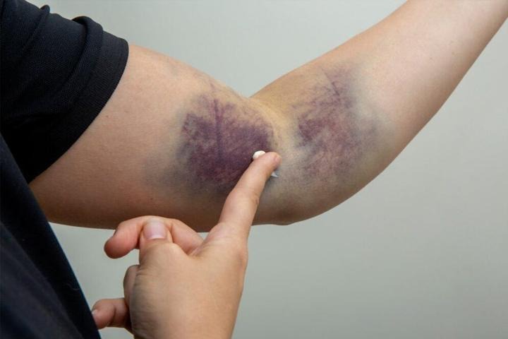 کمبود کدام ویتامین باعث کبودی بدن میشود