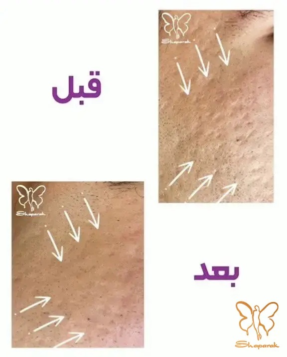 قبل و بعد درمان جای جوش با فوتونا در مشهد