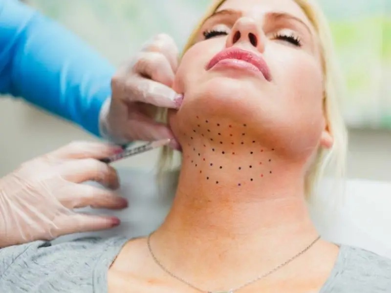 هزینه رفع غبغب با لیزر