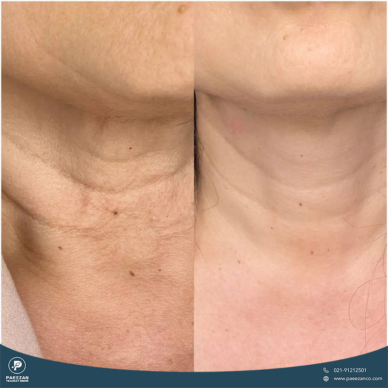عکس قبل و بعد جوانسازی گردن و رفع چین و چروک زیر گردن با تزریق پروفایلو