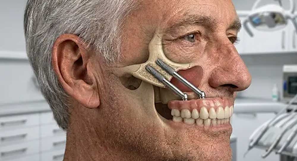 ایمپلنت زیگوماتیک چیست؟