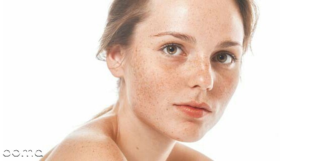 رفع لکه های قهوه ای صورت رفع لکه های قهوه ای صورت