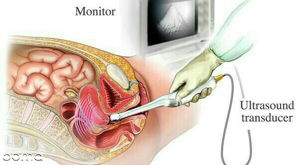 سونوگرافی واژینال چگونه انجام می شود؟