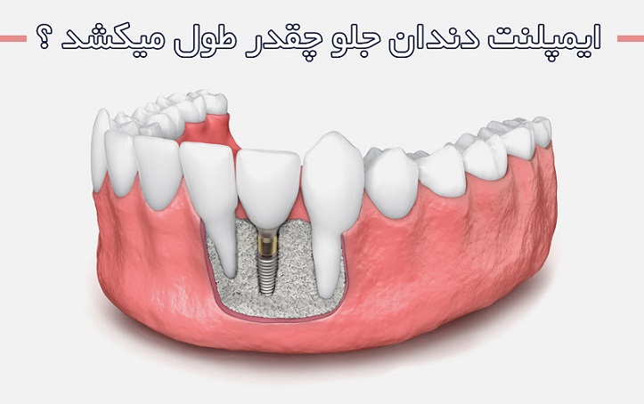 ایمپلنت دندان جلو چقدر طول میکشد ؟ ایمپلنت دندان جلو چقدر طول میکشد ؟