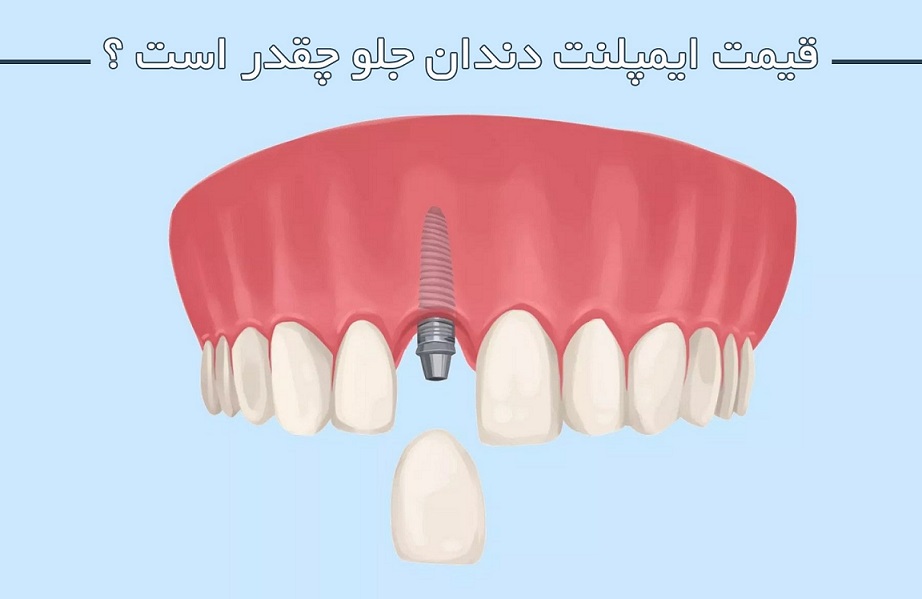 قیمت ایمپلنت دندان جلو چقدر است ؟ قیمت ایمپلنت دندان جلو چقدر است ؟