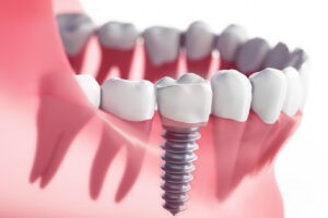 ایمپلنت دندان چیست؟ ایمپلنت دندان چیست؟
