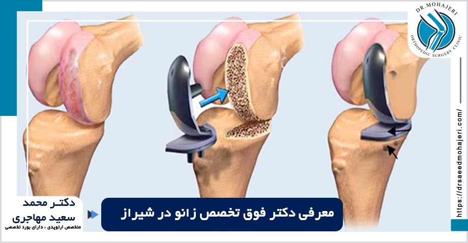 معرفی بهترین فوق تخصص زانو در شیراز معرفی بهترین فوق تخصص زانو در شیراز