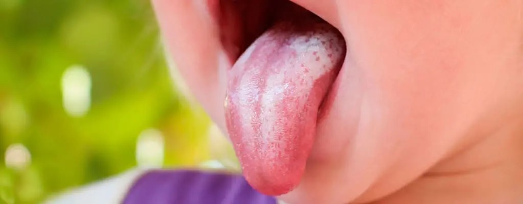 چگونه برفک دهان نوزاد را تشخیص دهیم و درمان کنیم؟ چگونه برفک دهان نوزاد را تشخیص دهیم و درمان کنیم؟