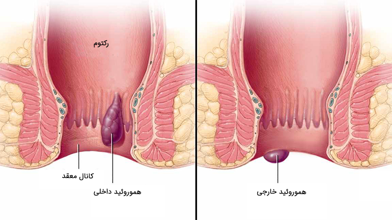 چرا عمل بواسیر با لیزر بهترین گزینه درمانی است؟ | بررسی واقعی همراه با هزینه و انتخاب پزشک چرا عمل بواسیر با لیزر بهترین گزینه درمانی است؟ | بررسی واقعی همراه با هزینه و انتخاب پزشک