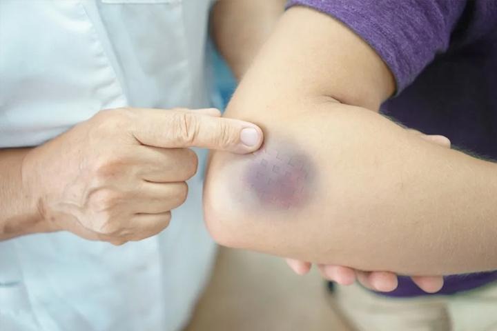 کمبود کدام ویتامین باعث کبودی بدن میشود؟ کمبود کدام ویتامین باعث کبودی بدن میشود؟