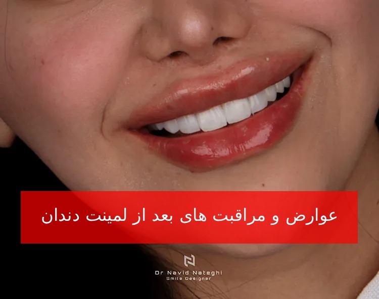 عوارض و مراقبت های بعد از لمینت دندان : دکتر ناطقی عوارض و مراقبت های بعد از لمینت دندان : دکتر ناطقی