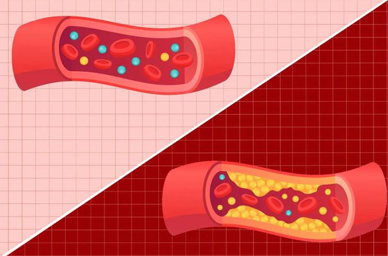 9 راهکار علمی کاهش کلسترول LDL: استراتژی تغذیه‌ای و سبک زندگی