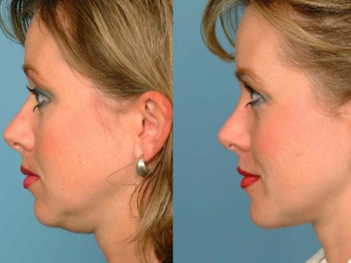 هزینه لیپوساکشن غبغب