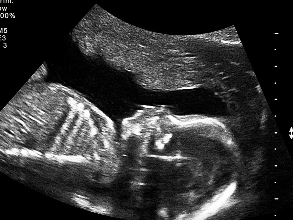 دقیق‌ترین روش‌های تعیین جنسیت از هفته 10 بارداری