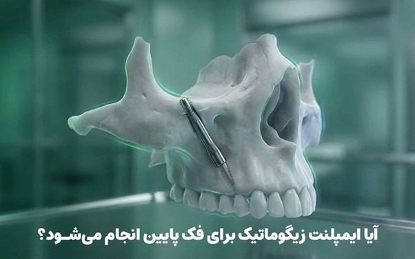 آیا ایمپلنت زیگوماتیک برای فک پایین انجام میشود؟ آیا ایمپلنت زیگوماتیک برای فک پایین انجام میشود؟