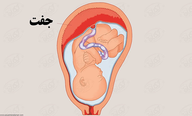 وضعیت قرارگیری جفت