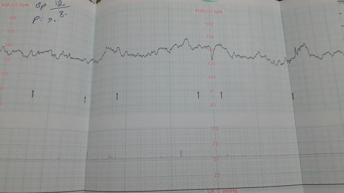 ضربان قلب جنین و فشار خون