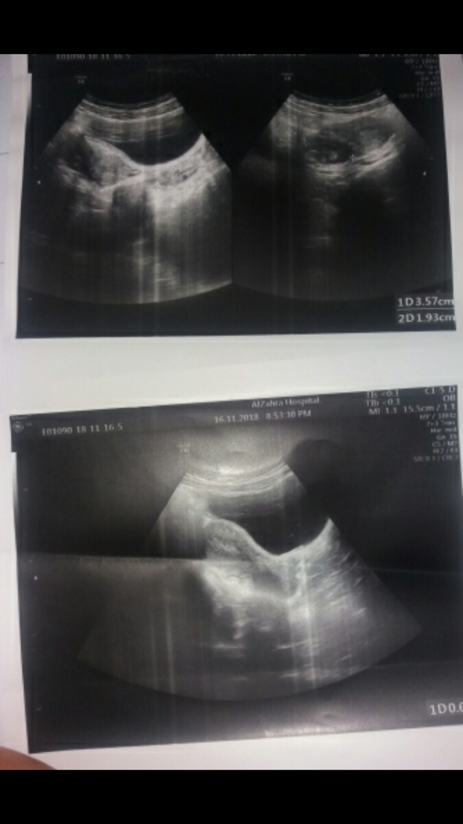 برسی سونوگرافی و تعین اینه یساک دیده میشه یا کیست