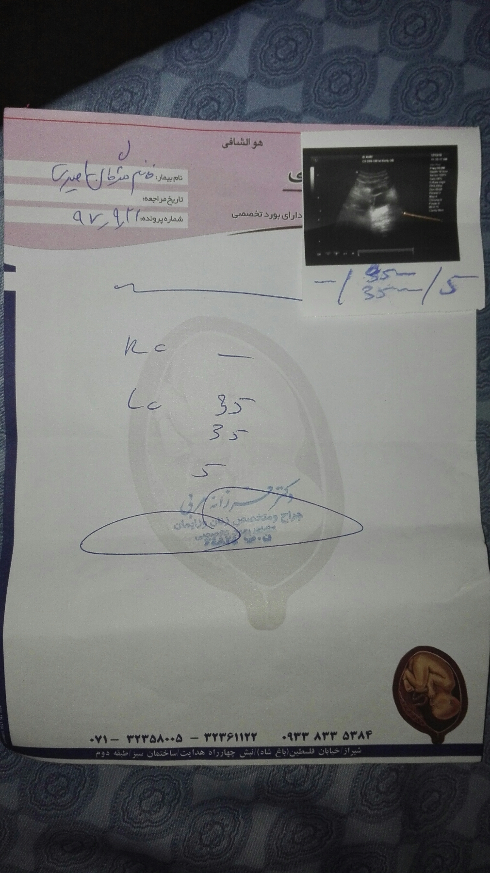 استرادیول بالا و سونو فولیکول