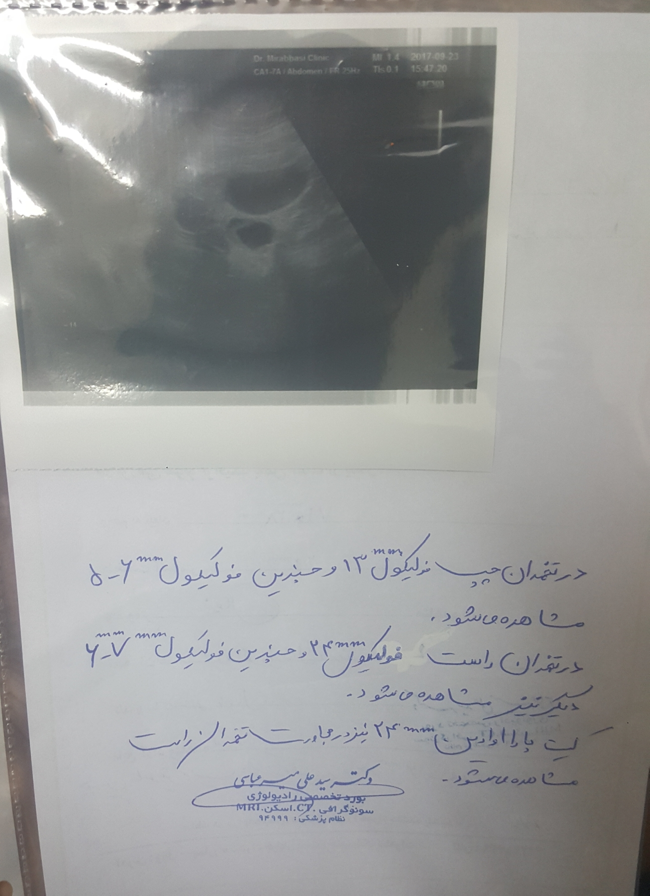تفسیر سونوگرافی تنبلی تخمدان تفسیر سونوگرافی تنبلی تخمدان